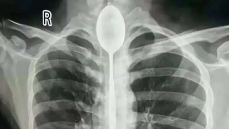 Парень год жил со столовой ложкой в животе, проглоченной во время пьянки