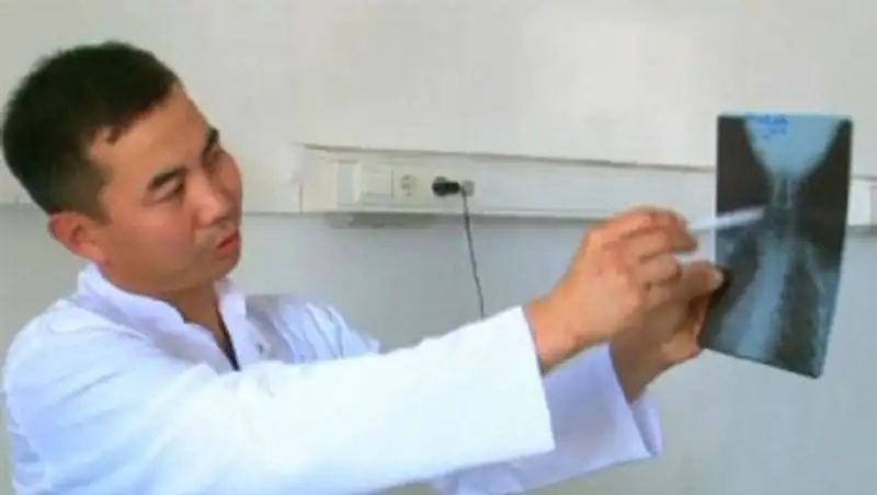 В Кызылорде 3-летний ребенок проглотил кусочек проволоки