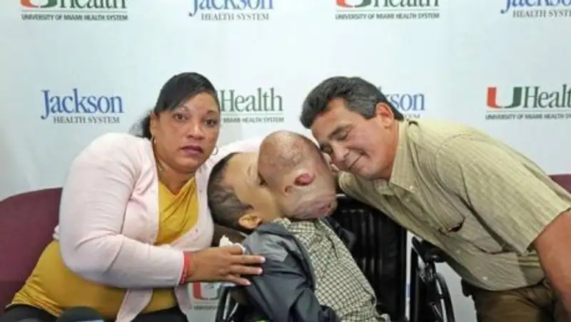 В США умер мальчик после удаления гигантской опухоли лица