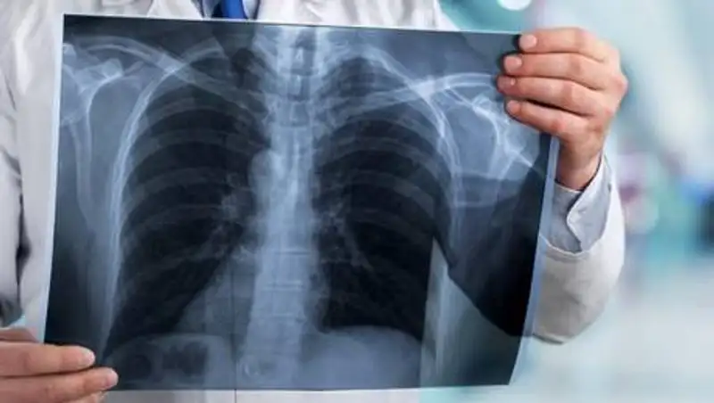 Кого и как в РК отправляют на принудительное лечение от туберкулеза