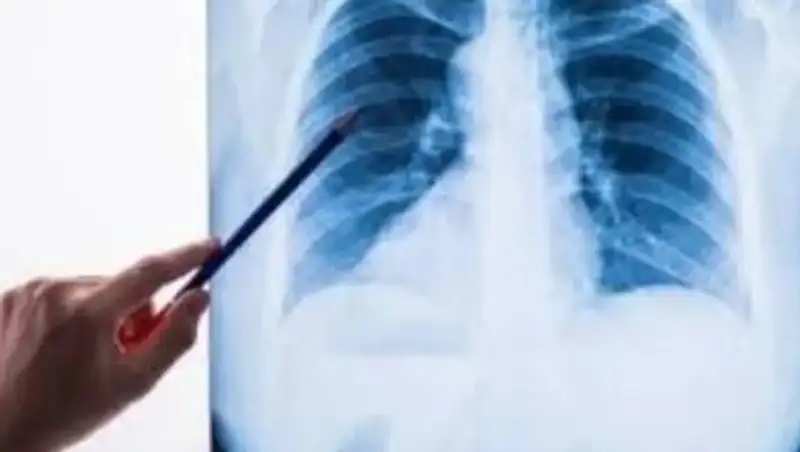 Увеличилось число заболевших пневмонией в Казахстане