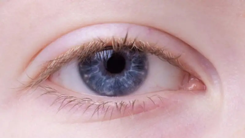 Первые симптомы астигматизма у детей