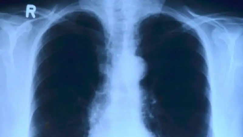 Советы доктора: как отличить  туберкулез от коронавируса