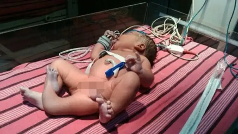 В Индии родилась девочка с тремя ногами