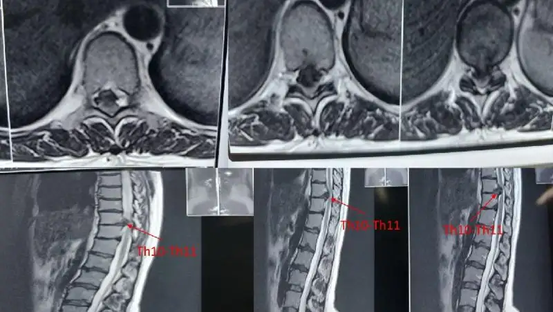 Советы врачей: как не «заработать» грыжу диска грудного отдела