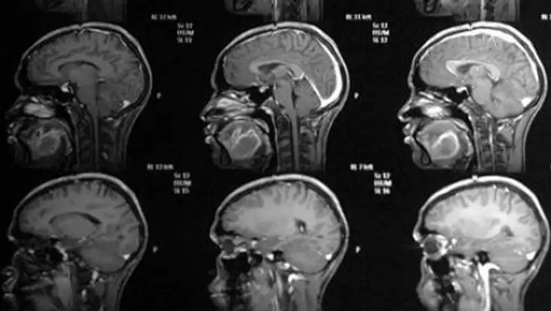 Онколог назвал первые признаки рака головного мозга