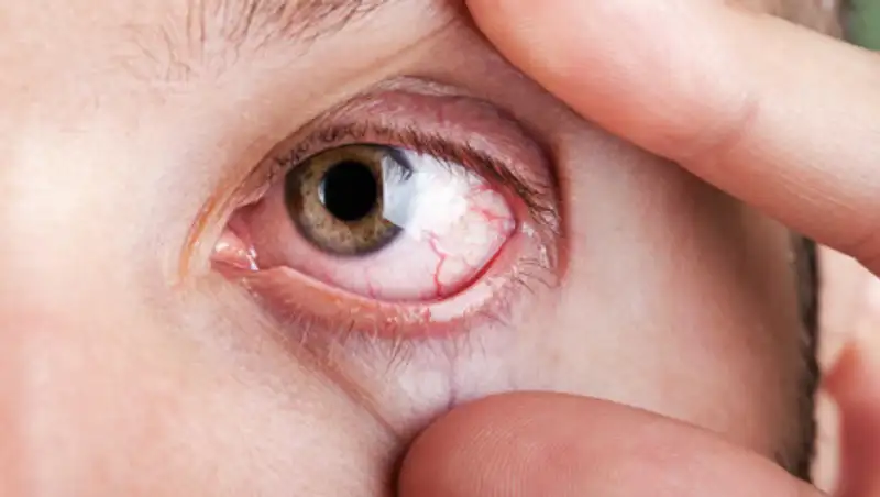 Причины, прогноз и лечение кровоизлияния в глазах