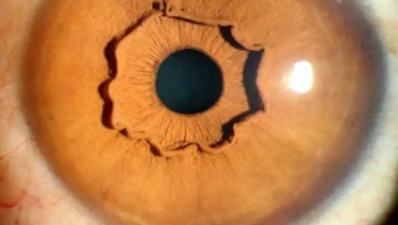 В Китае живет женщина с уникальными глазами, похожими на кратер на Марсе