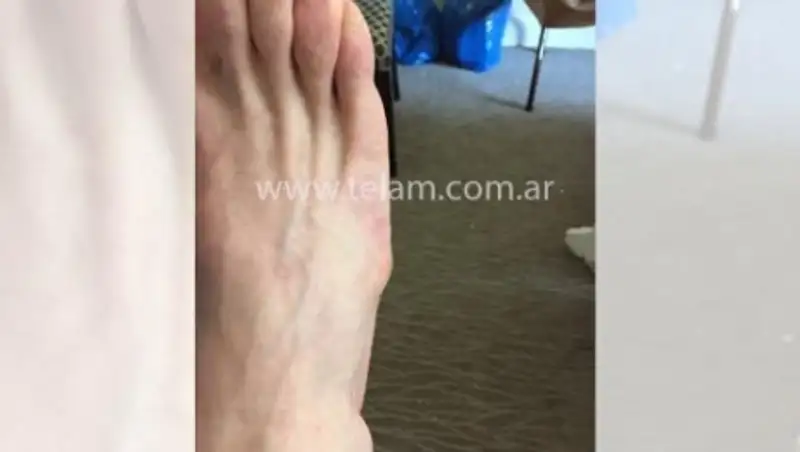 В сети появилась фотография травмы Месси