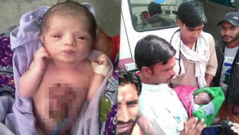 В Индии родился младенец с сердцем наружу