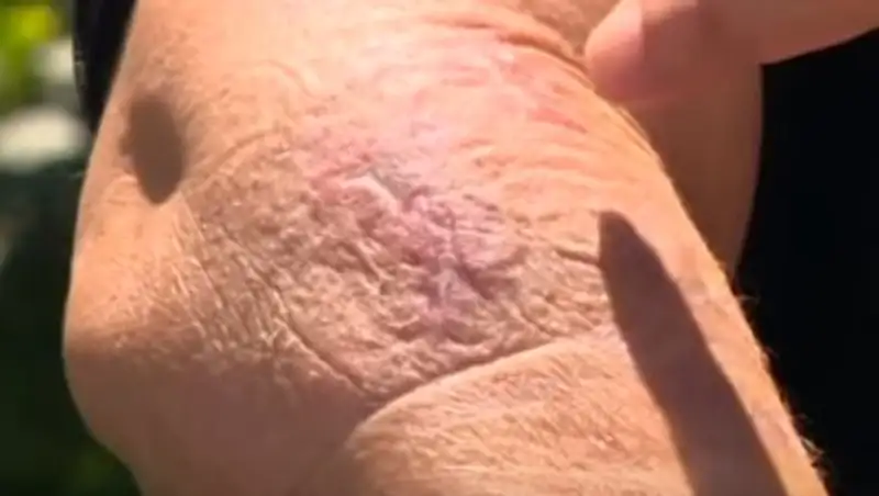 У жительницы Алматинской области под кожей нашли паразитов