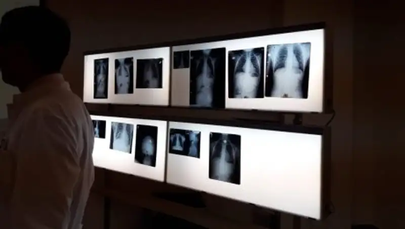 В Астане чаще всего из организма детей извлекают монеты по 50 тенге