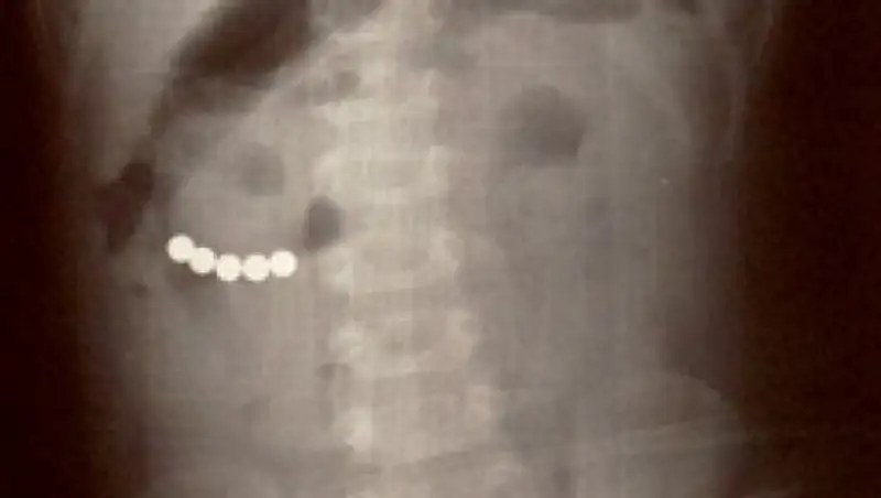 Врач прокомментировал состояние проглотившего магниты ребенка