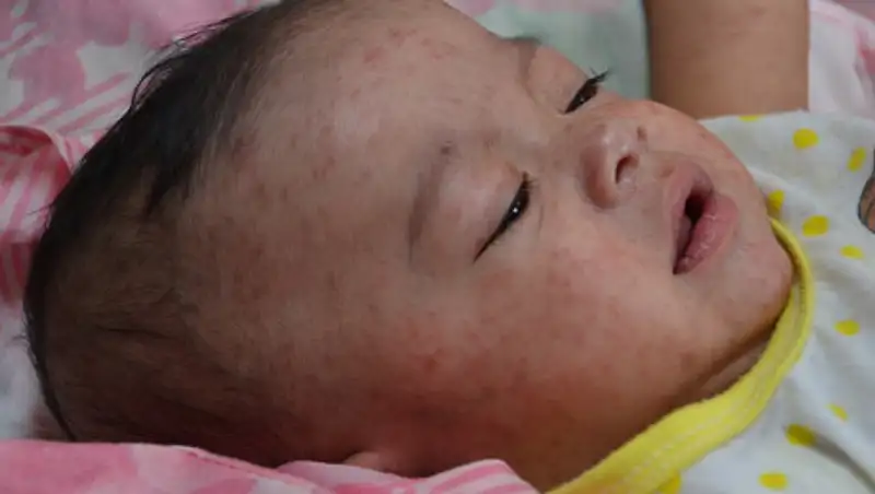 9 тысяч случаев кори зарегистрировано в РК