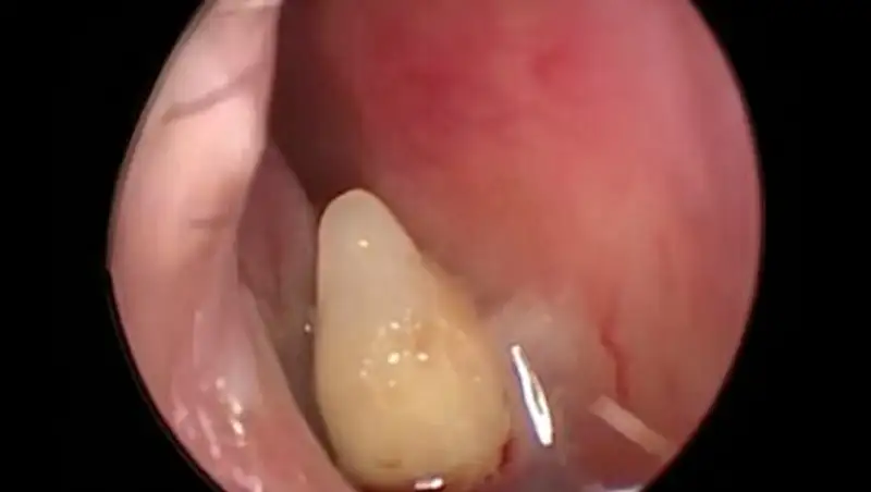 В Китае у женщины в носу вырос зуб