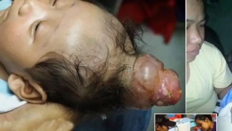 На Филиппинах родился "мальчик-единорог"