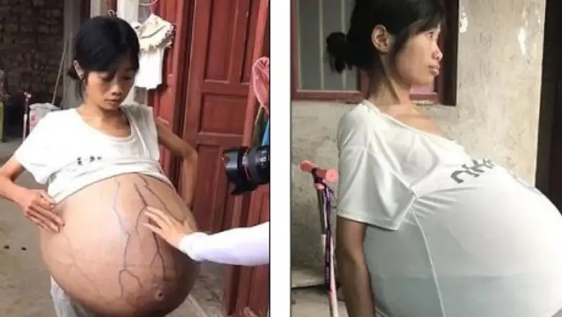 Живот женщины раздулся до аномальных размеров из-за загадочной болезни