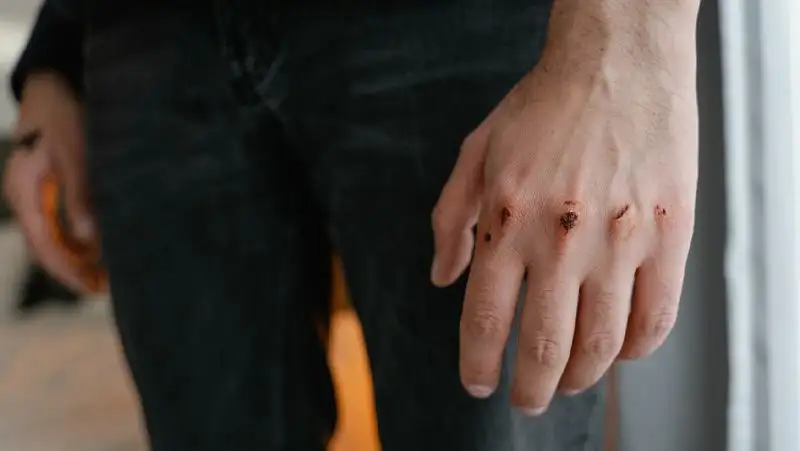 За долг в 40 тысяч тенге мужчине сломали 15 ребер