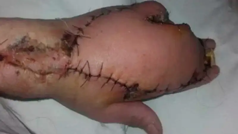 Женщина получила царапину от кота и лишилась пальца