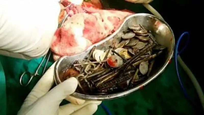 Из желудка индийца извлекли монеты, сотню гвоздей и цепь для собак