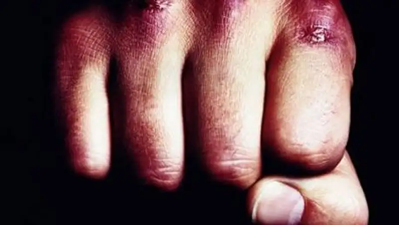 В Зыряновске мужчина избил сожительницу,а затем уже в больнице пытался перерезать ей горло