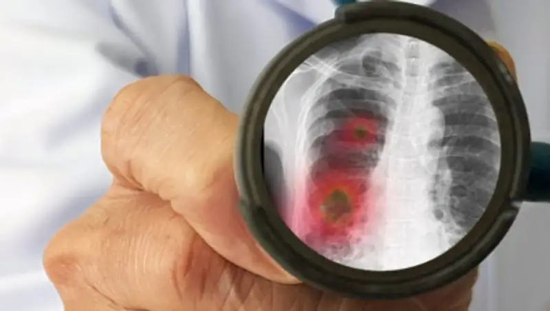 787 случаев коронавирусной пневмонии выявили за сутки в Казахстане