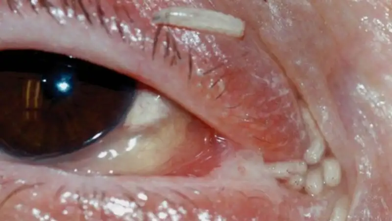 Сто двадцать личинок извлекли из глаз и ушей женщины