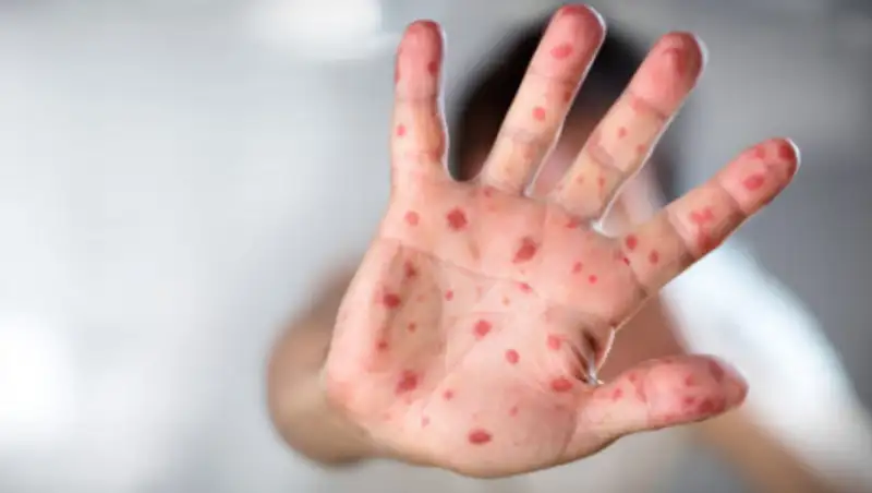 В Казахстане появились два серотипа кори