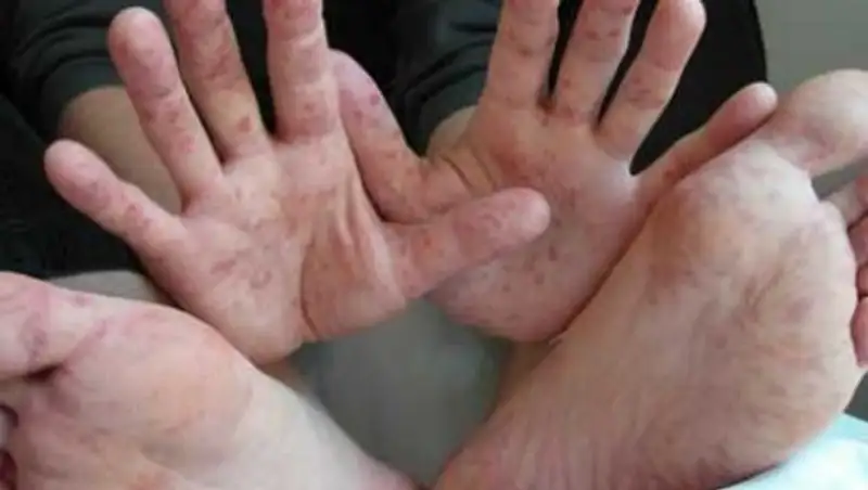 Вирус коксаки: казахстанские туристы подхватили инфекцию в турецком Белеке