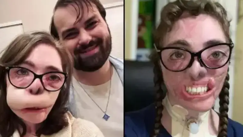 Женщина показала восстановленное после нападения собаки лицо