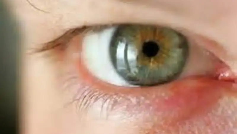 Что делать при "куриной слепоте"