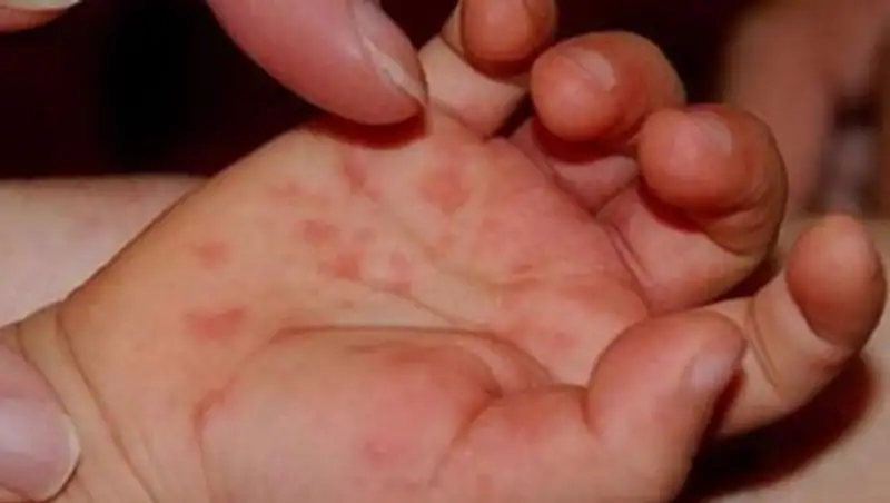 За 20 лет в Казахстане уровень заболеваемости корью снизился в 900 раз