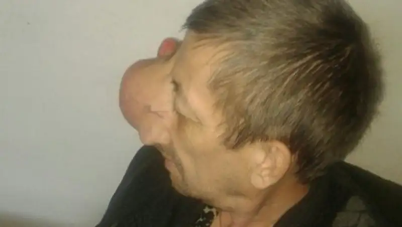 Жителю Аркалыка долгие годы мешает жить жуткая опухоль  