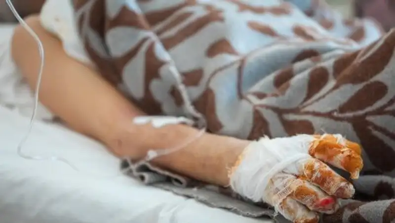 Учитель получил сильные ожоги во время ремонта крыши в школе