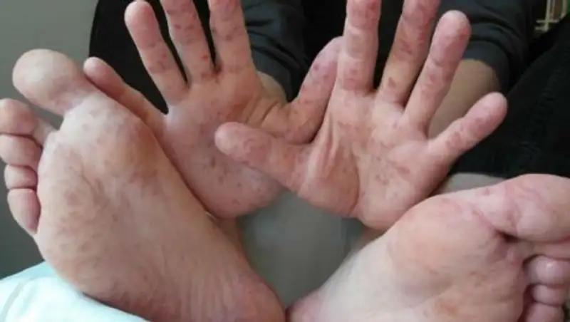 Среди казахстанских туристов не выявили вирус Коксаки – Минздрав РК