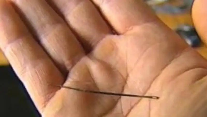 Хирурги Кабардино-Балкарии вытащили иглу из сердца 13-летней девочки