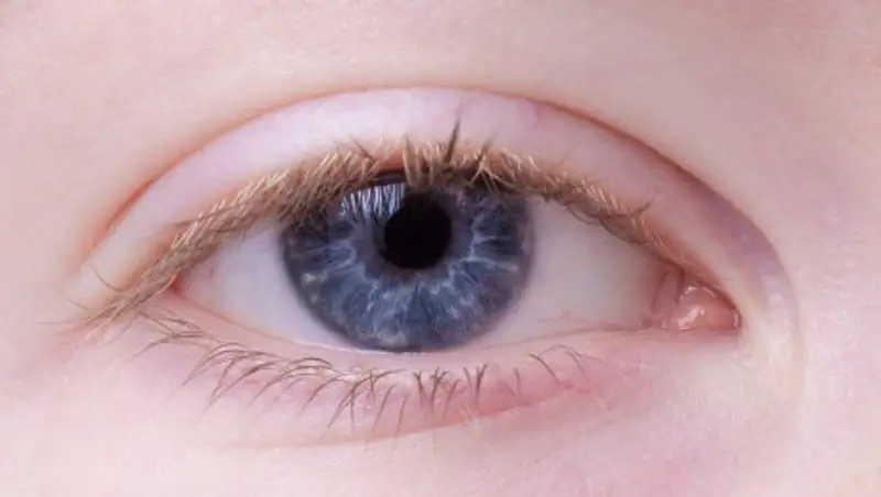 Коррекция зрения при астигматизме