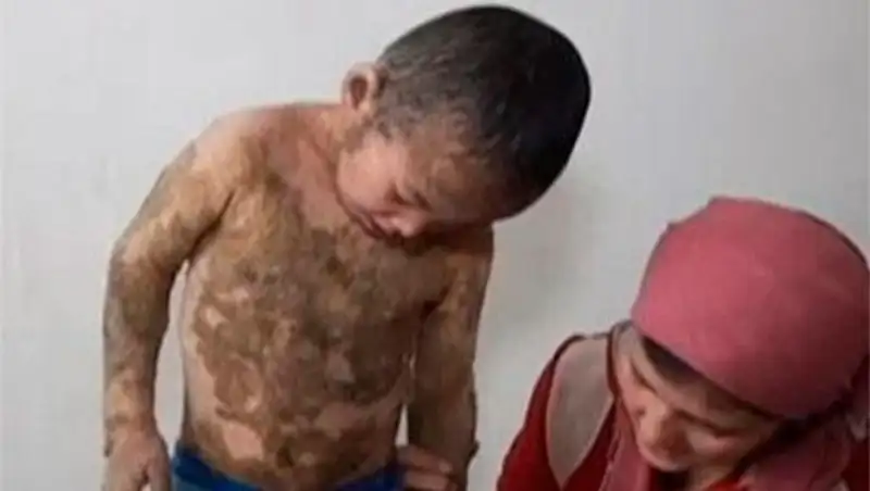 Мальчику из Кызылорды с редкой формой ихтиоза собрали 2 500 000 тенге