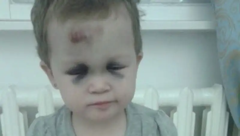 В Кызылорде из частного детсада ребенок попал в больницу с тяжелыми травмами