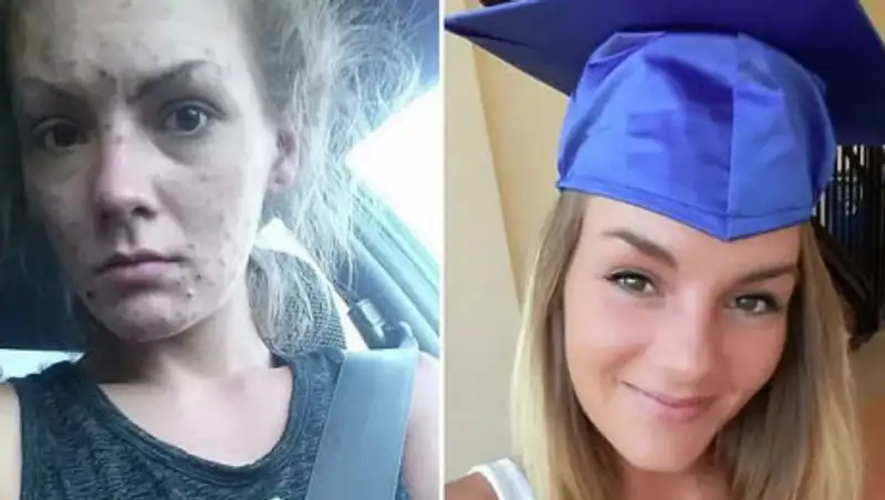 Девушка показала поразительное изменение после отказа от наркотиков