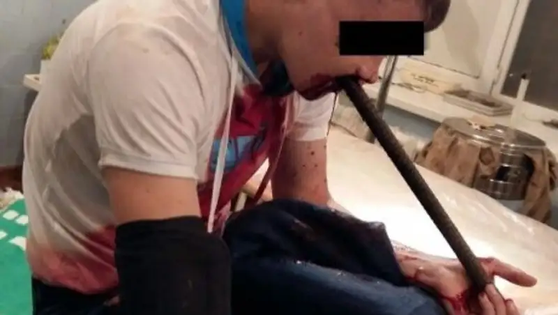В Караганде выписали парня, которому в результате ДТП в рот вонзилась арматура