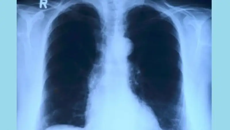 Что нужно знать о раке легких