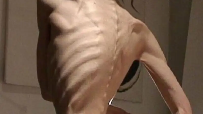 14-летнюю девочку весом 25 килограммов забрали у матери