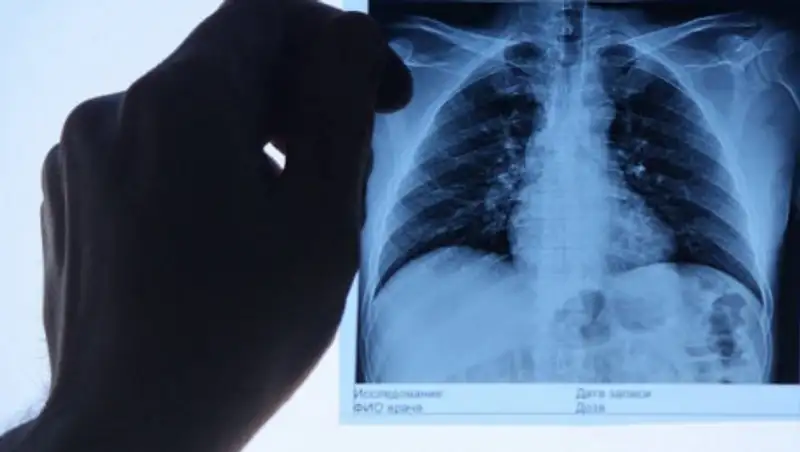 77 заболевших пневмонией зарегистрировали за сутки в Казахстане