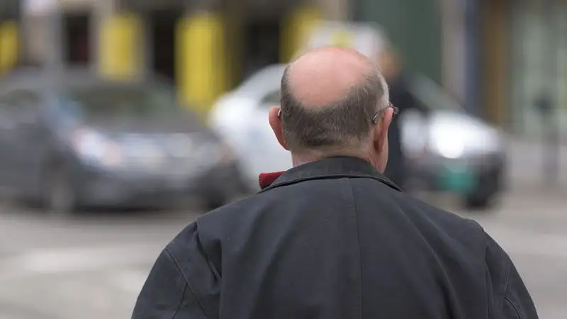 Что стимулирует выпадение волос