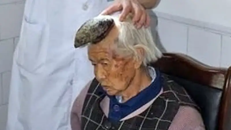 Из-за редкого заболевания китаянка стала единорогом