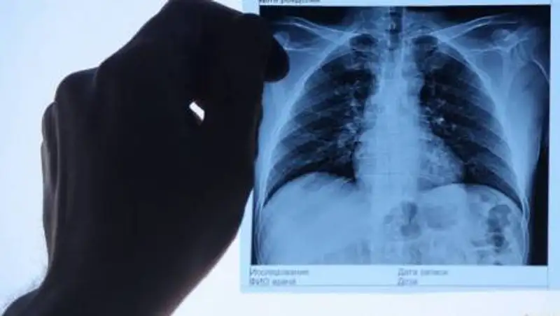 В Казахстане 4 человека скончались от коронавируса и пневмонии