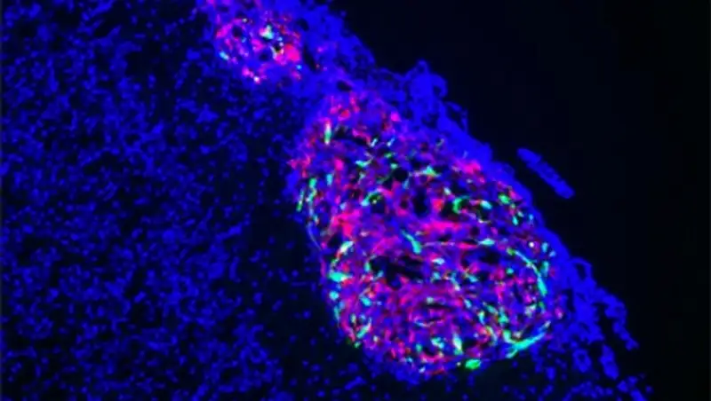 Обнаружен эффективный способ борьбы с раком мозга