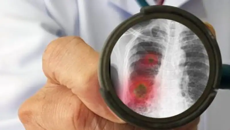 Новые случаи коронавирусной пневмонии выявлены в Казахстане