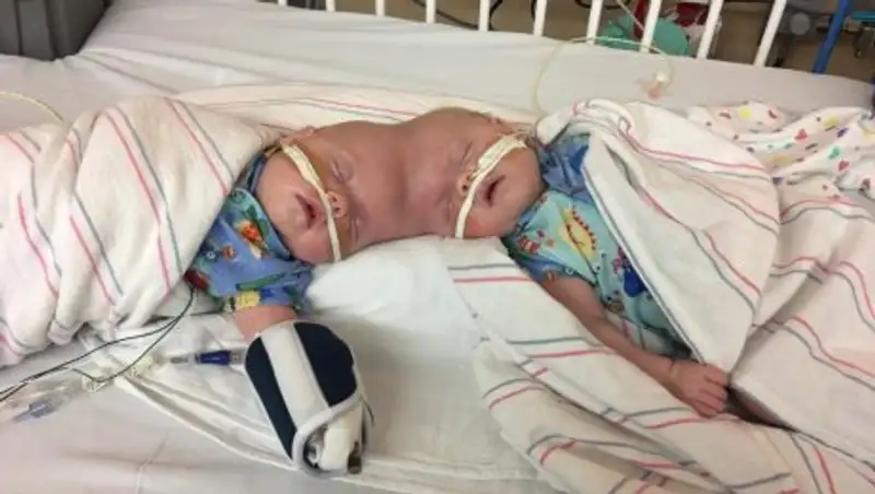 Сиамские близнецы со сросшимися головами первый день рождения отметили раздельно